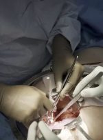 پیوند اندام حیوانات به انسان؛ کلیه خوک پیوندی پس از یک ماه هنوز به صورت نرمال کار می‌کند